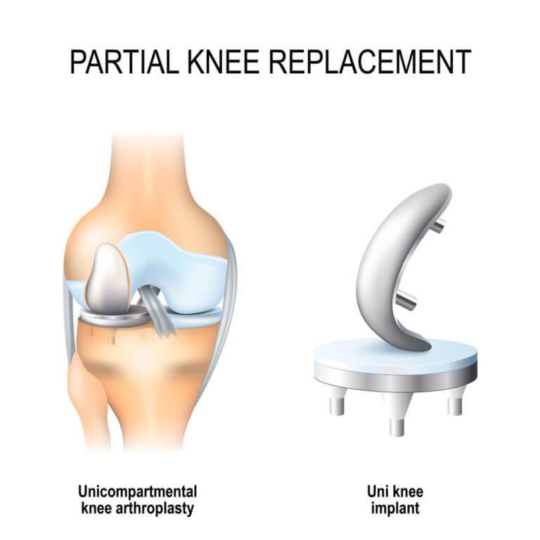 who-is-a-candidate-for-partial-knee-replacement_1752240921